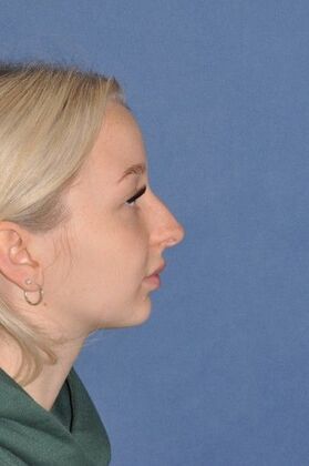 Rhinoplasty: Tip pulls down and bump - Before