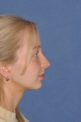 Rhinoplasty: Tip pulls down and bump - After