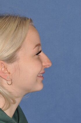 Rhinoplasty: Tip pulls down and bump - Before