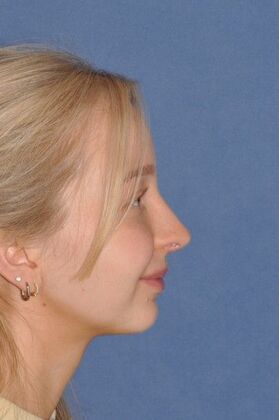 Rhinoplasty: Tip pulls down and bump - After