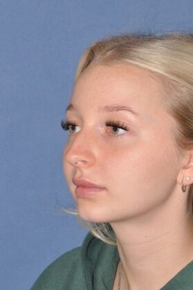 Rhinoplasty: Tip pulls down and bump - Before