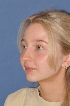 Rhinoplasty: Tip pulls down and bump - After