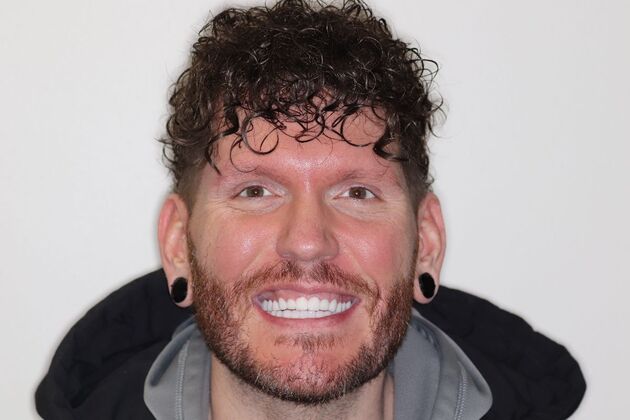 Smile Makeover Travis - Before