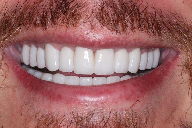 Smile Makeover: Travis - After