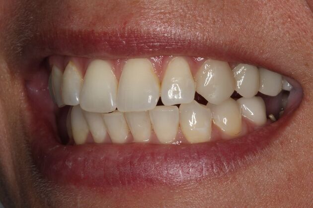 Cosmetic Dentistry: Amber - Whiter Teeth Smile Transformation - Before