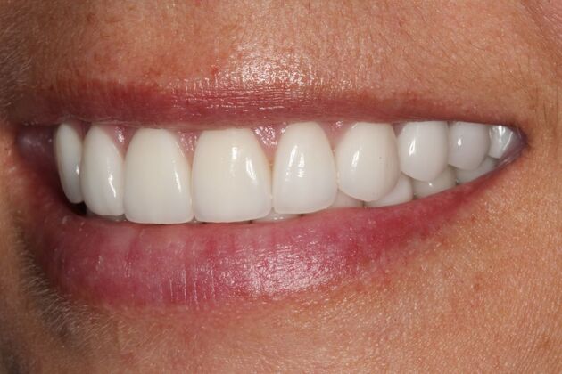 Cosmetic Dentistry: Amber - Whiter Teeth Smile Transformation - After