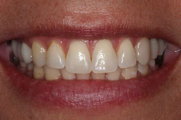 Cosmetic Dentistry: Amber - Whiter Teeth Smile Transformation - Before