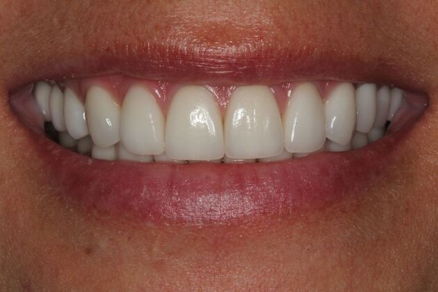 Cosmetic Dentistry: Amber - Whiter Teeth Smile Transformation - After