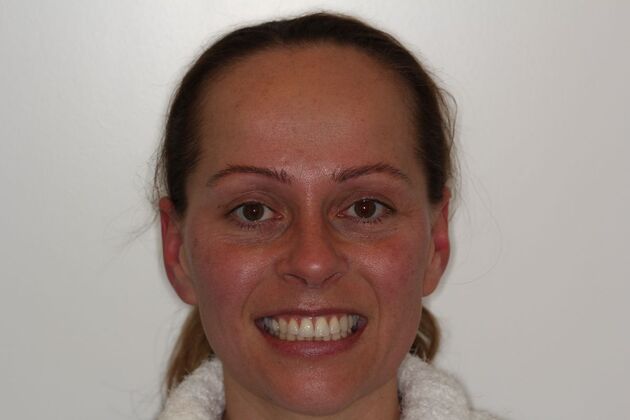 Cosmetic Dentistry Amber - Whiter Teeth Smile Transformation - Before