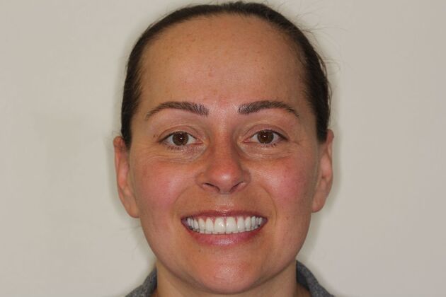Cosmetic Dentistry Amber - Whiter Teeth Smile Transformation - After