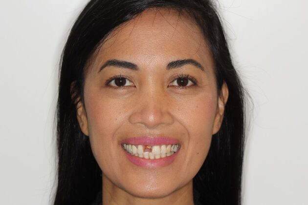 Dental Implants Joy - Front Dental Implant - Before