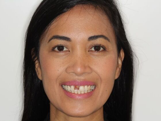 Dental Implants: Case 1: Joy - Before