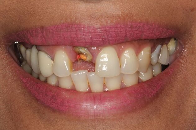 Dental Implants: Joy - Front Dental Implant - Before