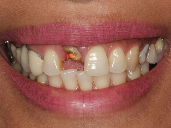 Dental Implants Case 1: Joy - Before