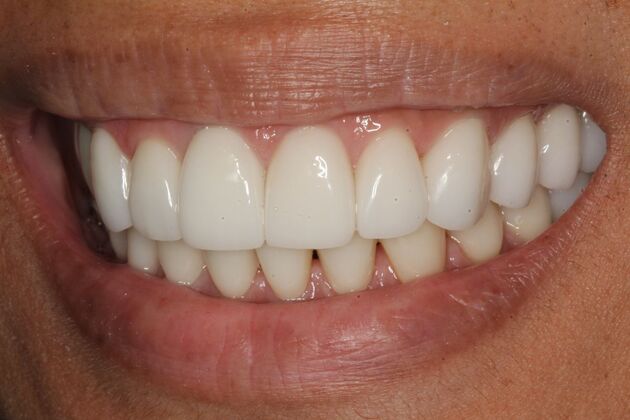Dental Implants: Joy - Front Dental Implant - After