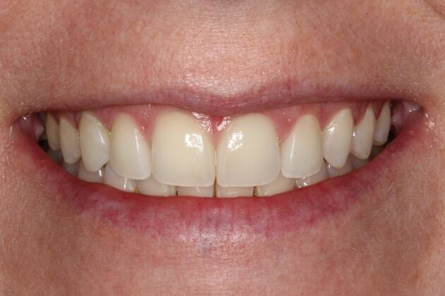 Invisalign Lippman - Invisalign Teeth Correction - After