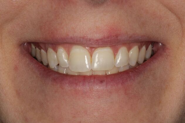 Invisalign Lippman - Invisalign Teeth Correction - Before