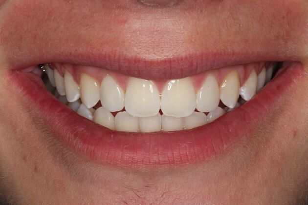 Invisalign: Nagy - Invisalign + Veneers - After