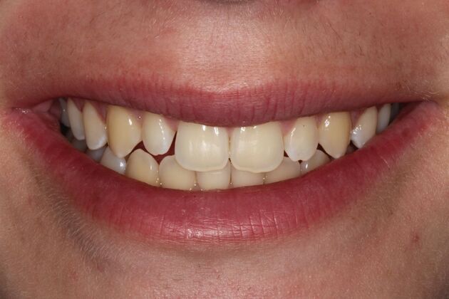 Invisalign: Nagy - Invisalign + Veneers - Before
