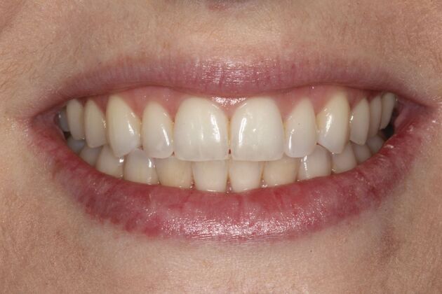 Cosmetic Dentistry Nicole - After