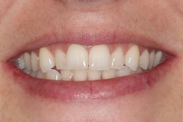 Cosmetic Dentistry Nicole - Before