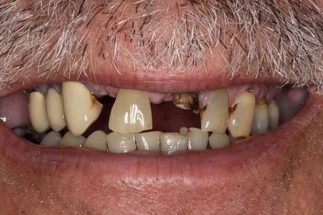 Dental Implants Trent - Multiple Dental Implants - Before