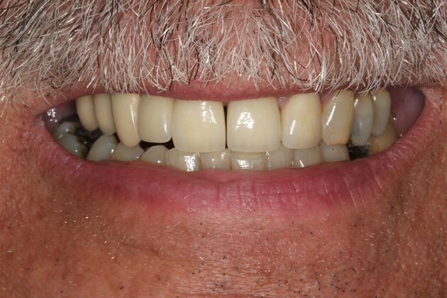Dental Implants Trent - Multiple Dental Implants - After