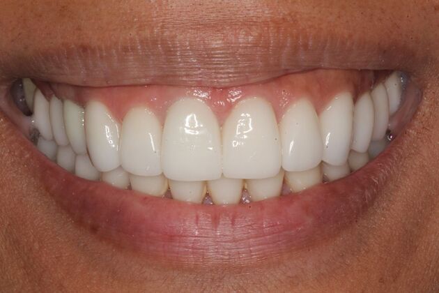 Dental Implants Wilkins - Front Tooth Dental Implant - After
