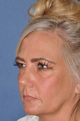 Endoscopic Browlift Upper Face Rejuvenation...Brow, Uppers, Lowers - Before