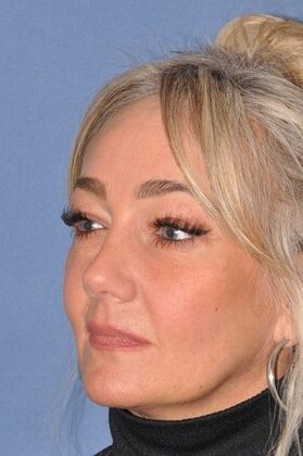Endoscopic Browlift Upper Face Rejuvenation...Brow, Uppers, Lowers - After