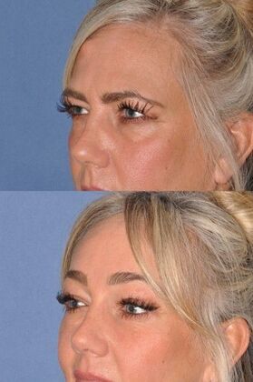 Endoscopic Browlift: Upper Face Rejuvenation...Brow, Uppers, Lowers - Before and after