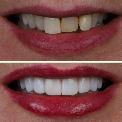 Minimal Prep Porcelain Veneers: Mary Beth - Before and After
