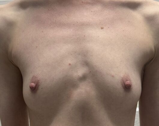 Breast Augmentation Case 824 - Before