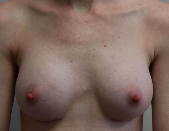Breast Augmentation Case 824 - After