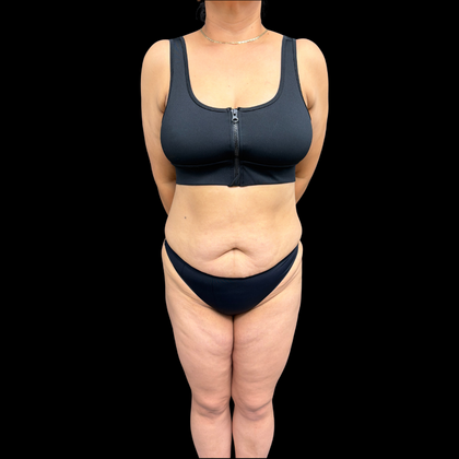 Brazilian Butt Lift: Case 34 - Before