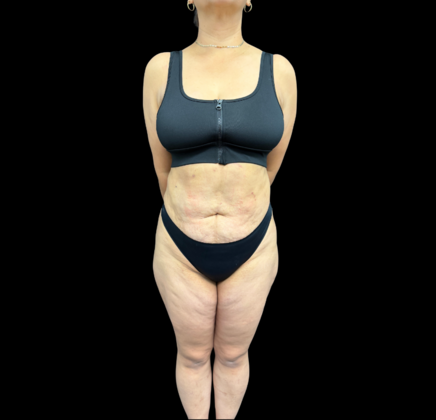 Brazilian Butt Lift: Case 34 - After