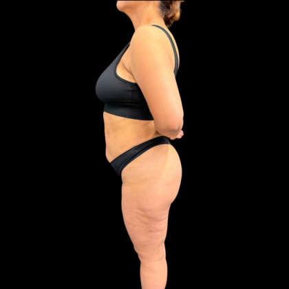 Brazilian Butt Lift: Case 34 - After