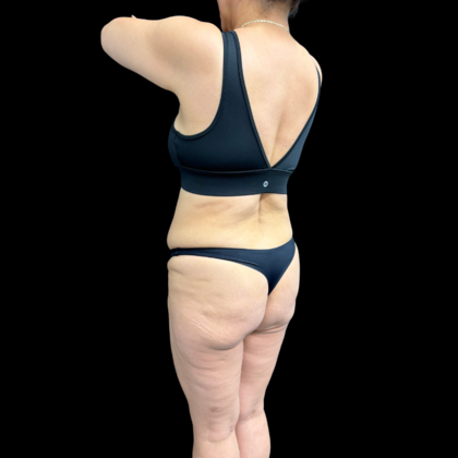 Brazilian Butt Lift: Case 34 - Before
