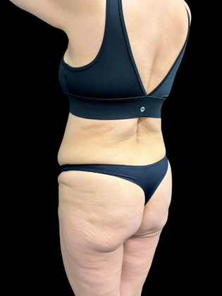Brazilian Butt Lift: BBL 2 - Before