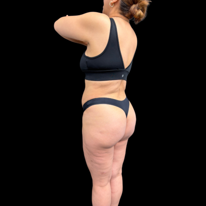 Brazilian Butt Lift: Case 34 - After