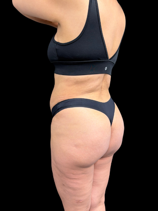 Brazilian Butt Lift: BBL 2 - After