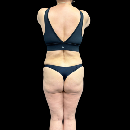 Brazilian Butt Lift: Case 34 - Before 