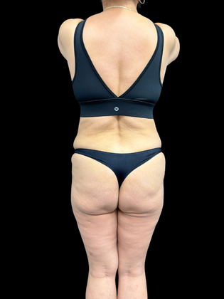 Brazilian Butt Lift: Case 3 - Before 