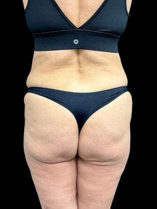 Brazilian Butt Lift BBL 2 - Before