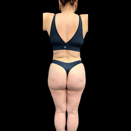 Brazilian Butt Lift: Case 34 - After 