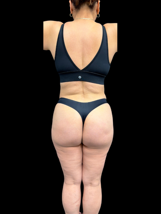 Brazilian Butt Lift: Case 3 - After 