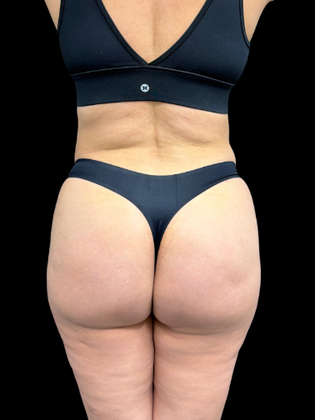 Brazilian Butt Lift BBL 2 - After