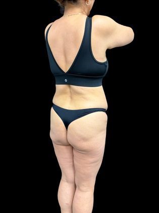 Brazilian Butt Lift Case 3 - Before