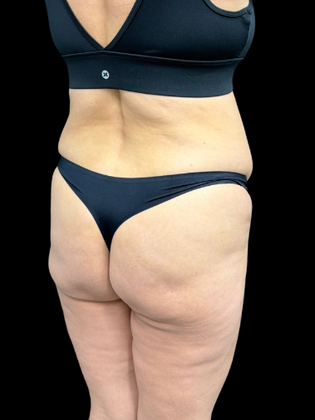 Brazilian Butt Lift: BBL 2 - Before
