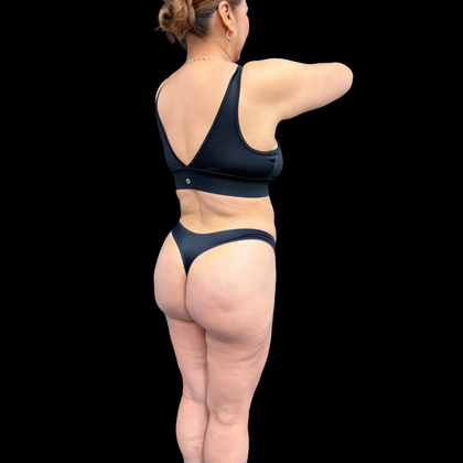 Brazilian Butt Lift Case 34 - After